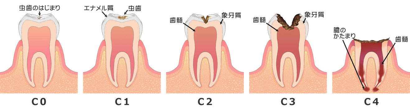 虫歯の進行